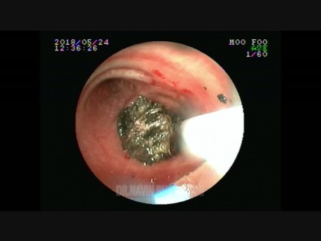 Fulguration par laser d'un carcinoïde bronchique droite