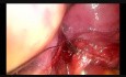 La Lobectomie moyenne, la chirurgie thoracoscopique vidéo-assistée uniportale (CTVA -U).