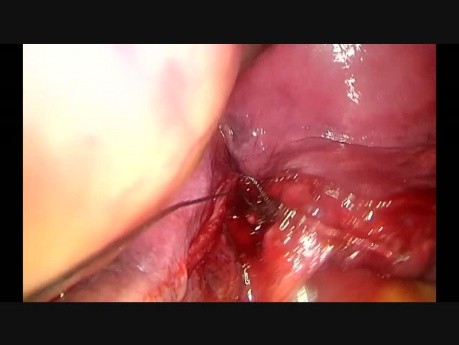 La Lobectomie moyenne, la chirurgie thoracoscopique vidéo-assistée uniportale (CTVA -U).