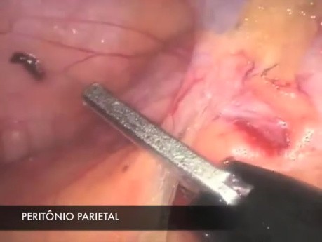 Proctocolectomie Laparoscopique pour le Traitement de la Polypose Adénomateuse Familiale (PAF)