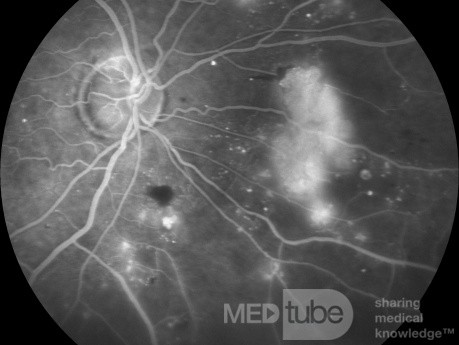 Rétinopathie diabétique proliférative en angiographie en fluorescence.