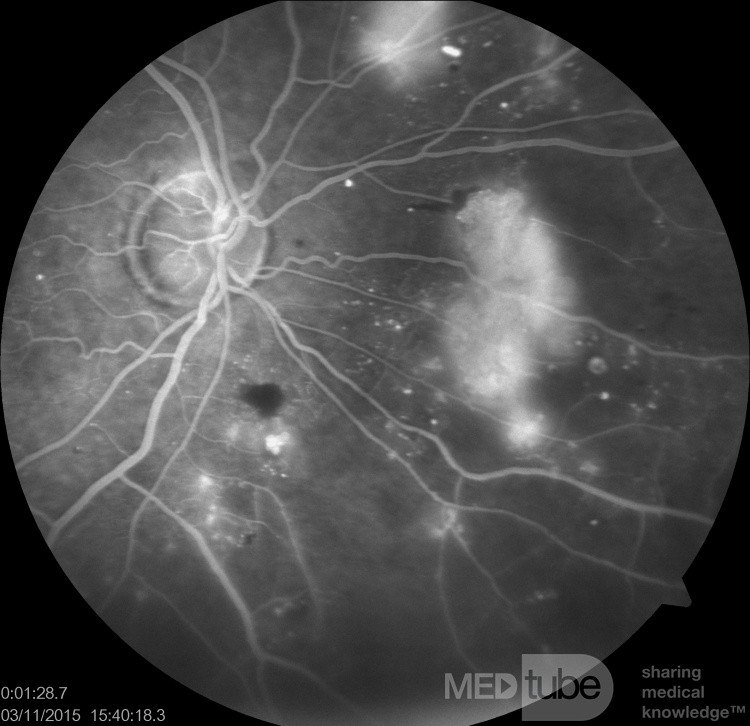 Rétinopathie diabétique proliférative en angiographie en fluorescence.