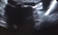 Énorme Thrombus dans l'Oreillette Gauche