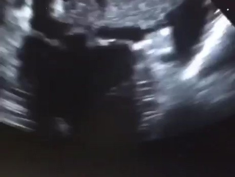 Énorme Thrombus dans l'Oreillette Gauche