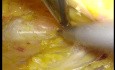 Curage Ganglionnaire Inguinal Laparoscopique pour le Cancer du Pénis