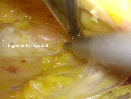 Curage Ganglionnaire Inguinal Laparoscopique pour le Cancer du Pénis