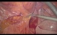 Diverticulite aiguë compliquée avec une fistule colovésicale