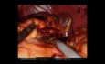 Gastrectomie Robotique, Splénectomie et Pancréatectomie Distale pour Masse Gastrique