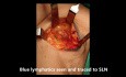 Biopsie du ganglion sentinelle dans le cancer du sein