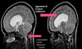 Ventriculostomie du Troisième Ventricule dans un Cas de Syndrome d'Aicardi Bénin avec Hydrocéphalie Obstructive