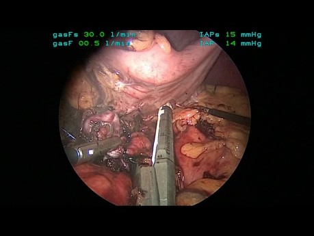 Résection laparoscopique de l'artère splénique pour le traitement de 4 anévrismes de l'artère