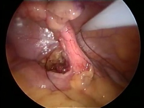 Appendicectomie  par incision unique (SILS)