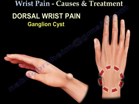 Causes et traitement de la douleur au poignet - Partie 2