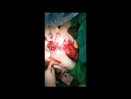 Thrombectomie de greffe chirurgicale après pancréatoduodénectomie