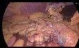 Gastrectomie Atypique Laparoscopique (Wedge Resection) - Tumeur du GIST de la Courbure Gastrique