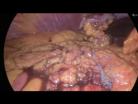 Gastrectomie Atypique Laparoscopique (Wedge Resection) - Tumeur du GIST de la Courbure Gastrique