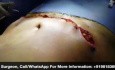 Lipo-Abdominoplastie