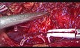 Curage ganglionnaire rétropéritonéal par voie laparoscopique