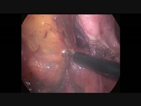 Colectomie totale par voie laparoscopique avec une anastomose iléoanale et un réservoir iléal en J