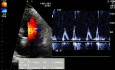 Patient souffrant d'hypertension. L'ECG, l'échocardiogramme et la fonction diastolique du ventricule gauche