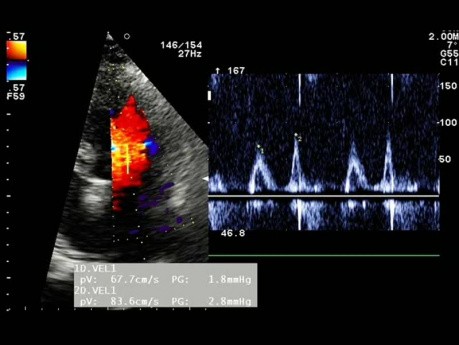 Patient souffrant d'hypertension. L'ECG, l'échocardiogramme et la fonction diastolique du ventricule gauche