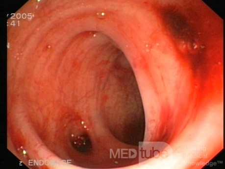 L'hémorragie diverticulaire - Diverticulose du côlon.