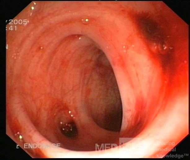 L'hémorragie diverticulaire - Diverticulose du côlon.