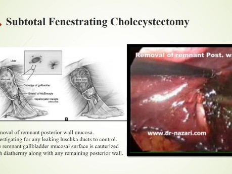 Cholécystectomie difficile