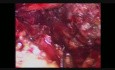 Oesophagectomie laparoscopique par voie transhiatale