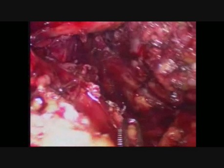 Oesophagectomie laparoscopique par voie transhiatale