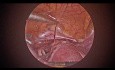 Cerclage Laparoscopique