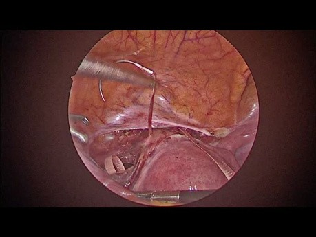 Cerclage Laparoscopique
