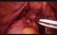 La résection antérieure basse par voie laparoscopique avec réparation intra-opératoire des fuites