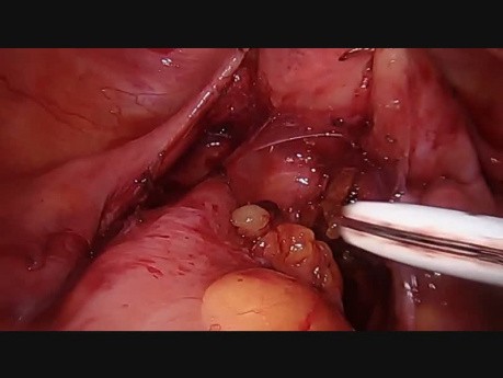 La résection antérieure basse par voie laparoscopique avec réparation intra-opératoire des fuites