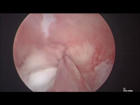 Ablation d'un Polype de l'Endomètre - Polypectomie