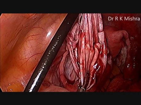 Kystectomie ovarienne par voie laparoscopique