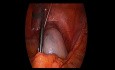 Tumorectomie Ovarienne Coelioscopique