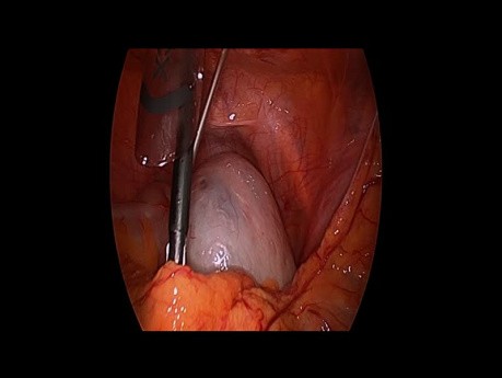 Tumorectomie Ovarienne Coelioscopique