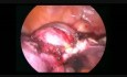 Hystérectomie laparoscopique de l'utérus avec un gros fibrome