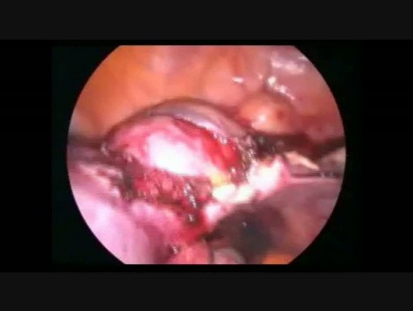 Hystérectomie laparoscopique de l'utérus avec un gros fibrome