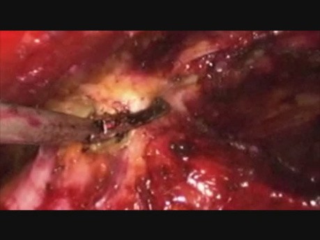 Traitement laparoscopique d'une hernie ombilicale par voie totalement extra-péritonéale (TEP)