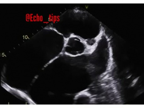 10. Cas d'échocardiographie - Quelle est la vue, les structures et le résultat ?