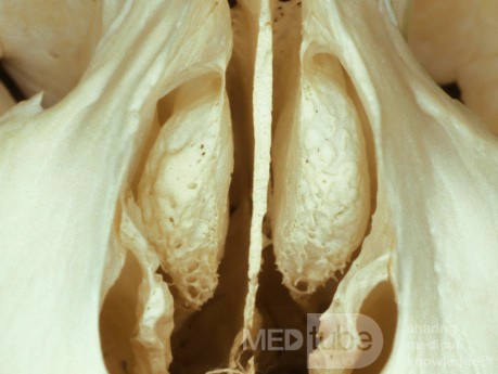 Concha bullosa bilatérale [spécimen ostéologique]