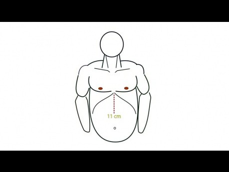 Application - Tutoriel Fundoplicature Géométrie, Chapitre 03 - l'organisation de la salle d'opération et positionnement des trocarts