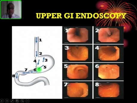 Endoscopie gastro-intestinale supérieure - un aperçu illustré
