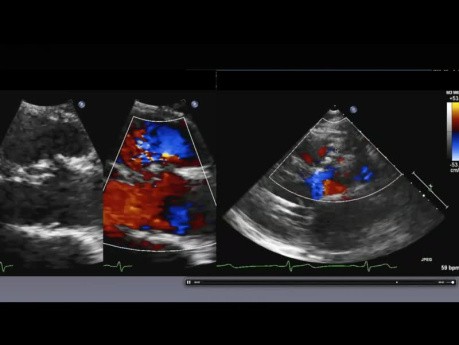 Études de Cas d'Echocardiographie à l'Hôpital St-Michel de Toronto