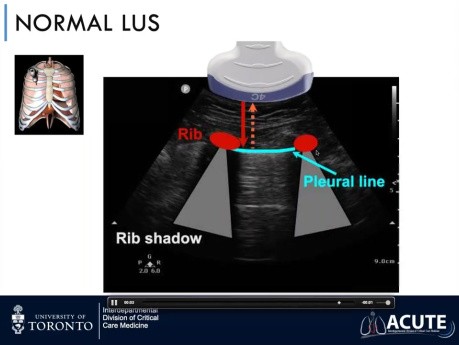 Échographie Pulmonaire dans l'Insuffisance Respiratoire Aiguë