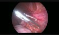 Adhésiolyse laparoscopique 