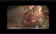 Chirurgie laparoscopique d'urgence pour l'appendicite perforée