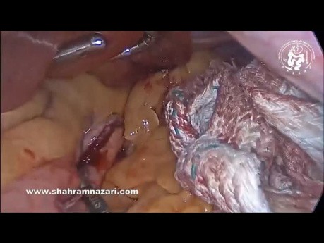 Gastrectomie Sleeve Laparoscopique